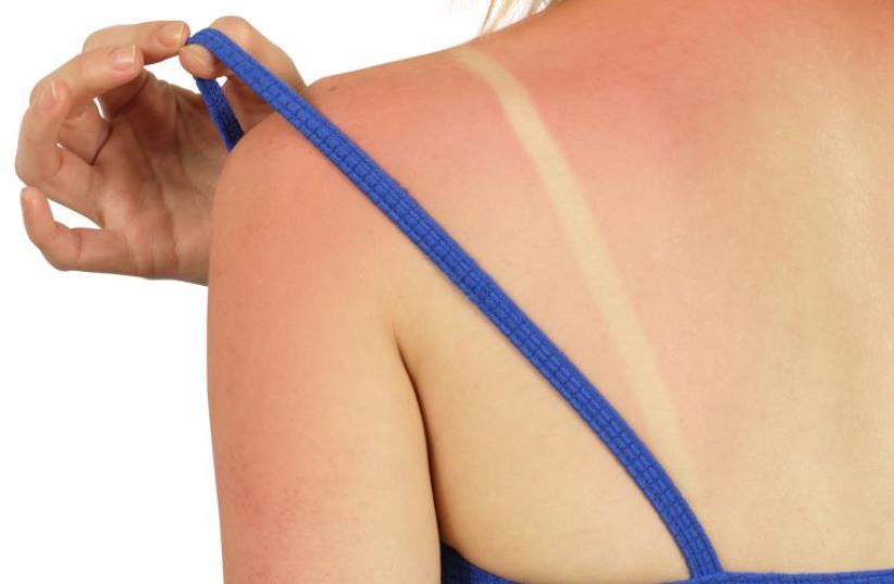 Woman with sunburn (illustrative). (photo credit: INGIMAGE)