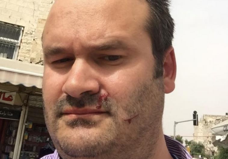 Opinion editor Seth Frantzman after being attacked in Jerusalem peace event