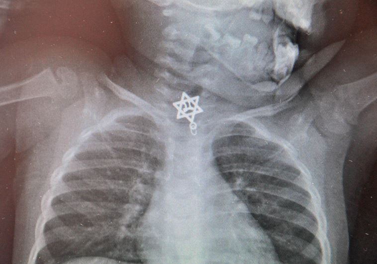 Star of David with “Life” inside threatens life of toddler when swallowed